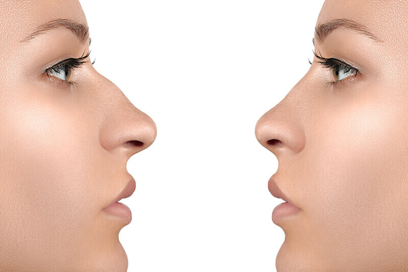 before and after photo of ultrasonic rhinoplasty procedure